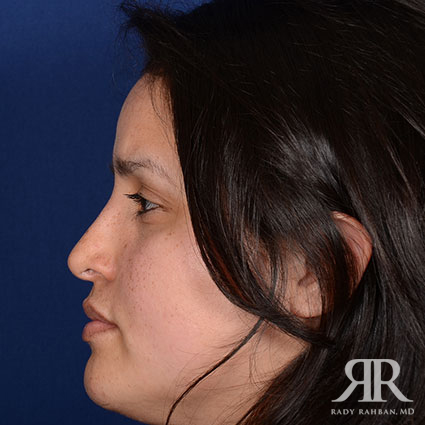 Ethnic Rhinoplasty