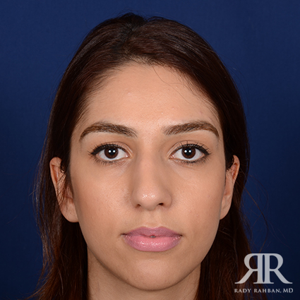 Ethnic Rhinoplasty