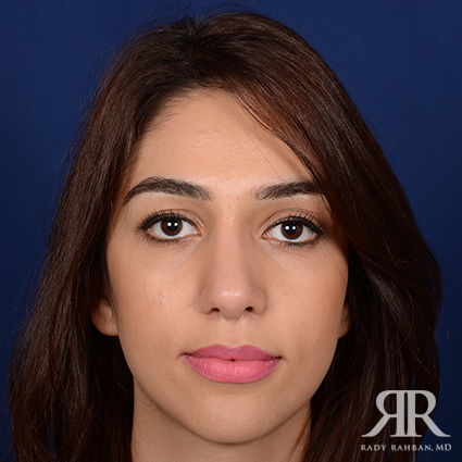 Ethnic Rhinoplasty