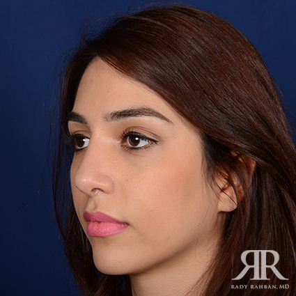 Ethnic Rhinoplasty