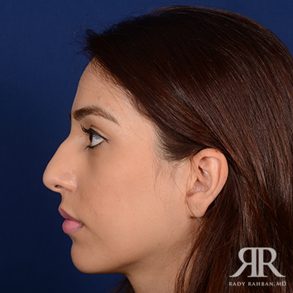 Ethnic Rhinoplasty