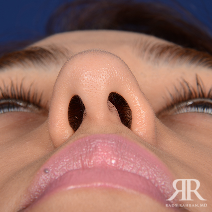 Ethnic Rhinoplasty