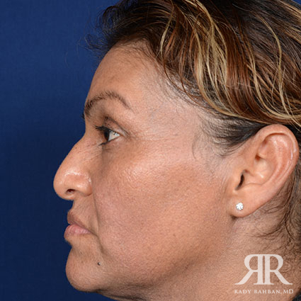 Ethnic Rhinoplasty