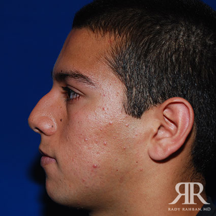 Ethnic Rhinoplasty