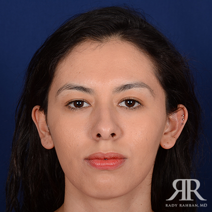 Ethnic Rhinoplasty