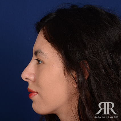 Ethnic Rhinoplasty