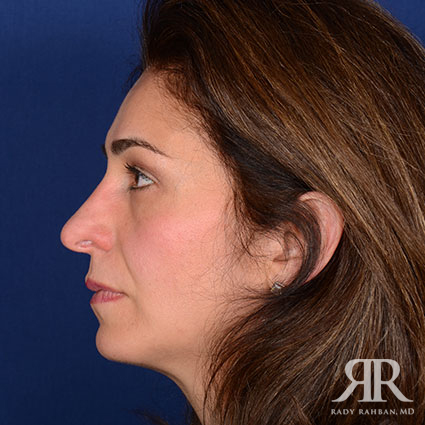 Ethnic Rhinoplasty