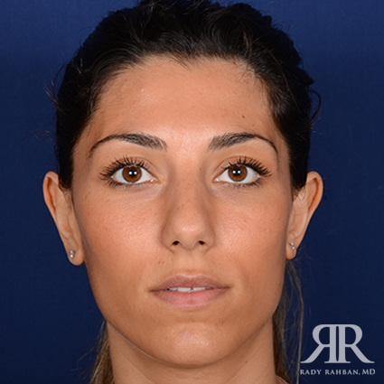 Ethnic Rhinoplasty