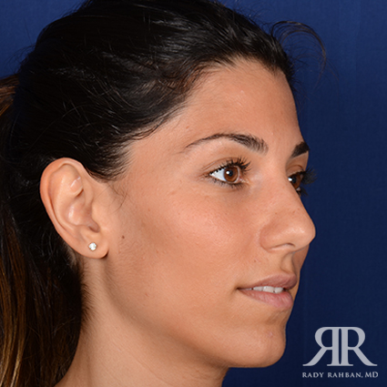 Ethnic Rhinoplasty