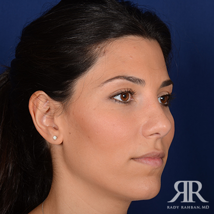 Ethnic Rhinoplasty