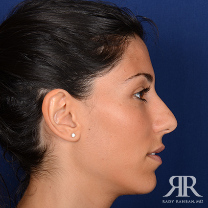 Ethnic Rhinoplasty