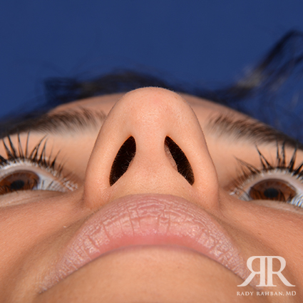 Ethnic Rhinoplasty