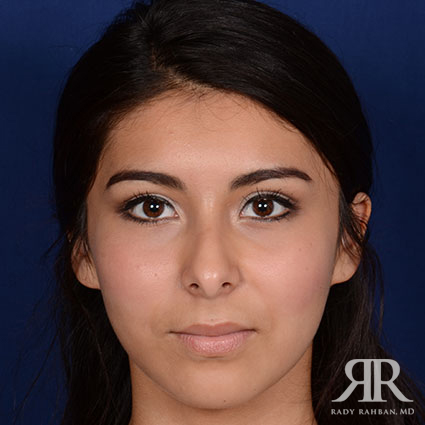 Ethnic Rhinoplasty