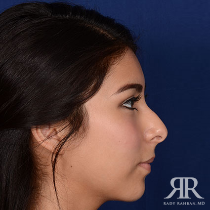 Ethnic Rhinoplasty