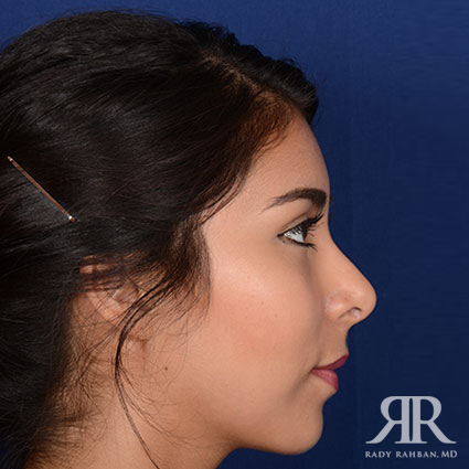 Ethnic Rhinoplasty