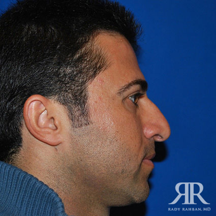 Ethnic Rhinoplasty