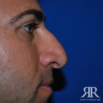 Ethnic Rhinoplasty