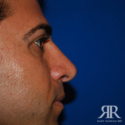 Ethnic Rhinoplasty