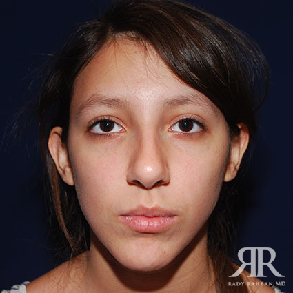 Ethnic Rhinoplasty