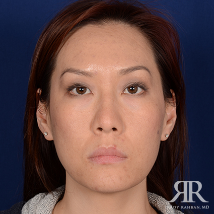 Ethnic Rhinoplasty