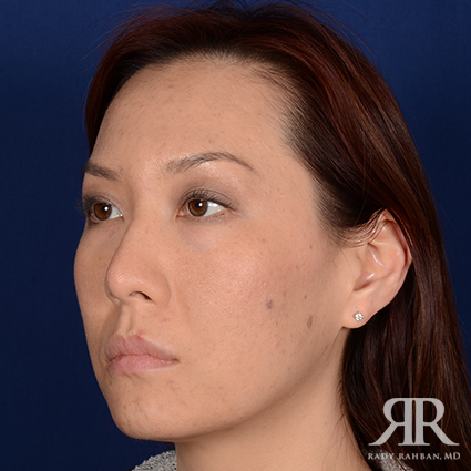 Ethnic Rhinoplasty