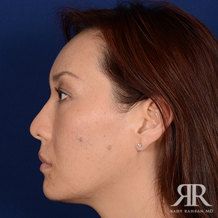 Ethnic Rhinoplasty