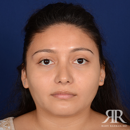 Ethnic Rhinoplasty