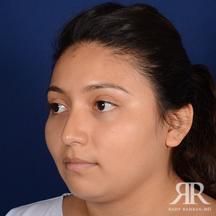 Ethnic Rhinoplasty