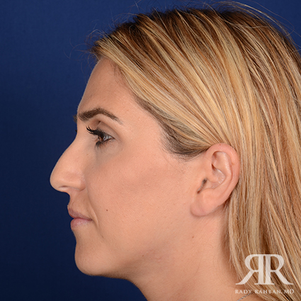 Ethnic Rhinoplasty