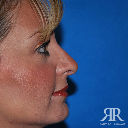 Ethnic Rhinoplasty