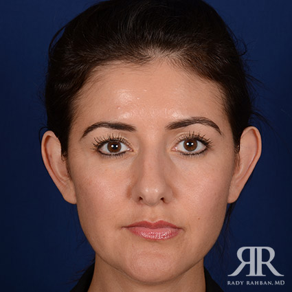 Ethnic Rhinoplasty