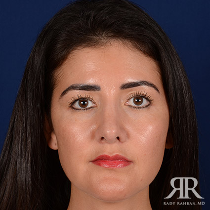 Ethnic Rhinoplasty