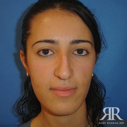 Ethnic Rhinoplasty