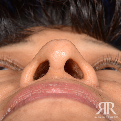 Ethnic Rhinoplasty