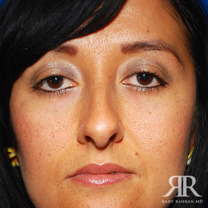 Ethnic Rhinoplasty