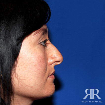 Ethnic Rhinoplasty