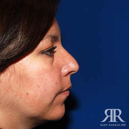 Ethnic Rhinoplasty