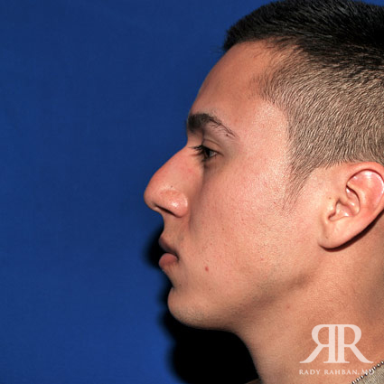 Ethnic Rhinoplasty