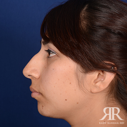 Ethnic Rhinoplasty