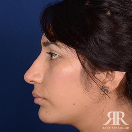 Ethnic Rhinoplasty