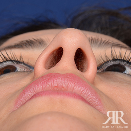 Ethnic Rhinoplasty