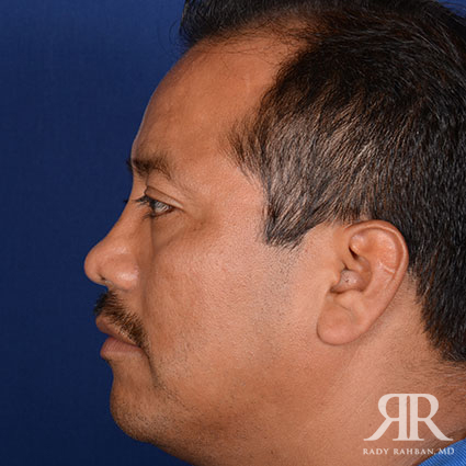 Ethnic Rhinoplasty