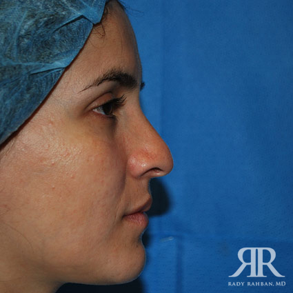 Ethnic Rhinoplasty