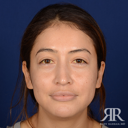 Ethnic Rhinoplasty