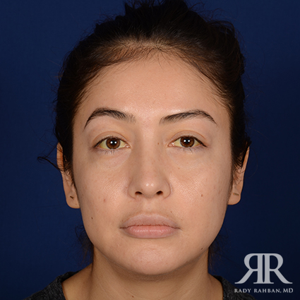 Ethnic Rhinoplasty