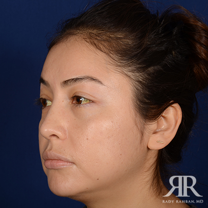 Ethnic Rhinoplasty