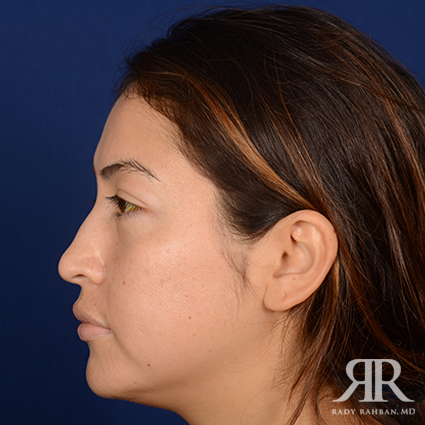 Ethnic Rhinoplasty