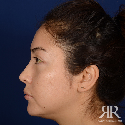 Ethnic Rhinoplasty