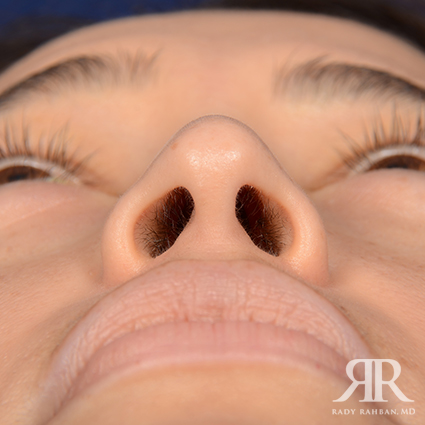 Ethnic Rhinoplasty