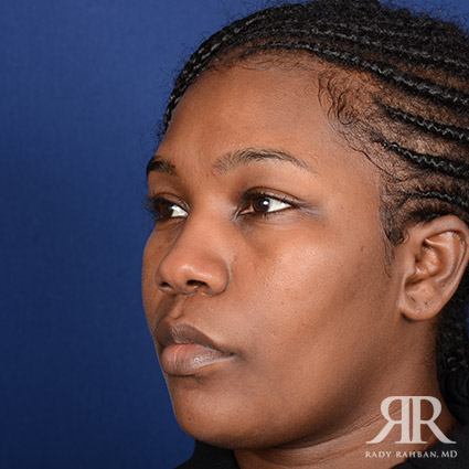 Ethnic Rhinoplasty